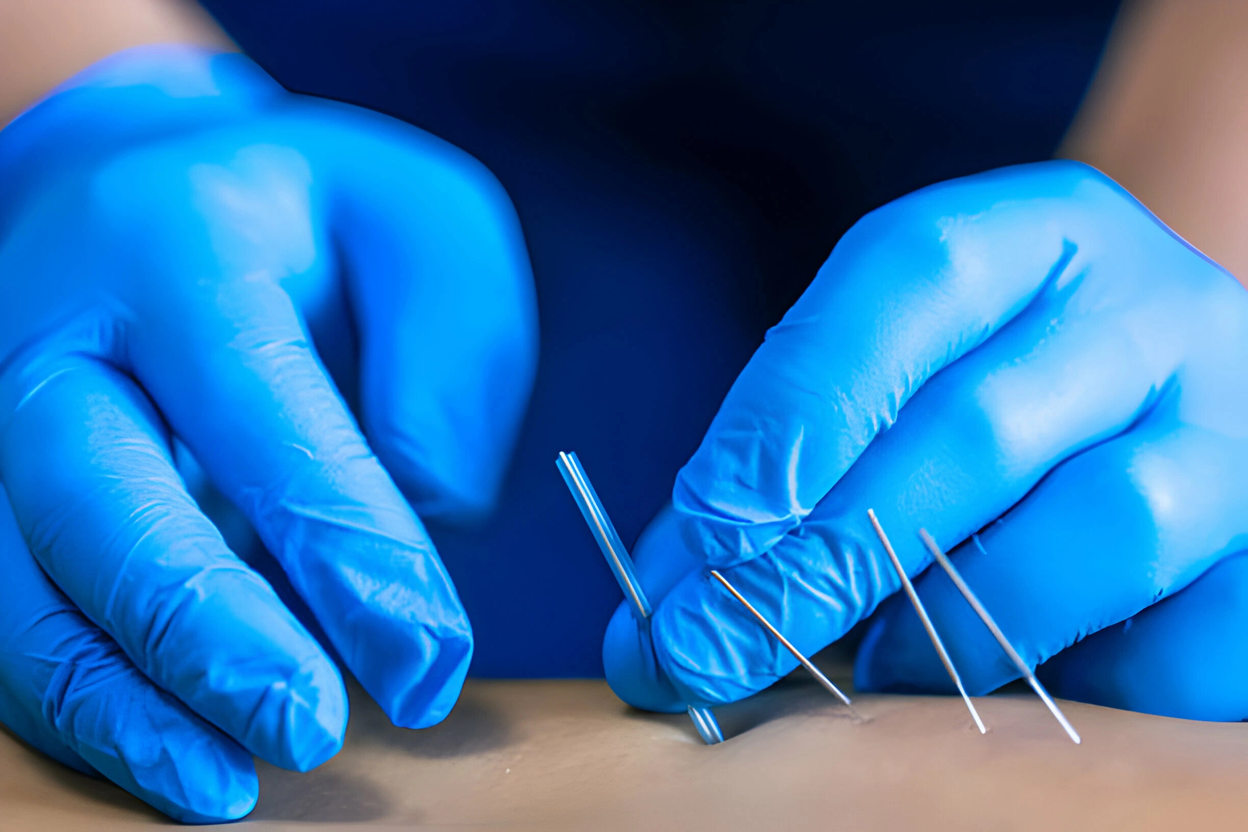 Dry needling